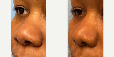 Rhinoplasty before and after photo