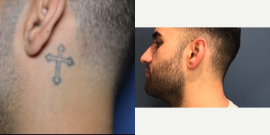 Tattoo Removal before and after photo