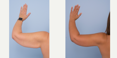 Arm Lift before and after photo