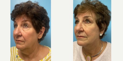 Facelift before and after photo