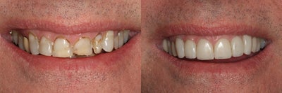 Porcelain Veneers before and after photo