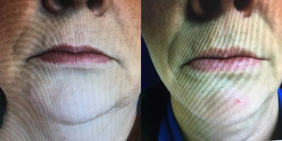 Restylane Silk before and after photo