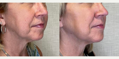 Voluma before and after photo