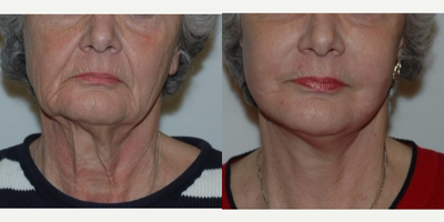 Facelift before and after photo