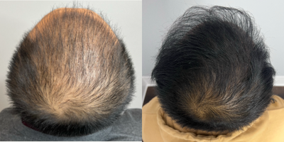 FUE Hair Transplant before and after photo