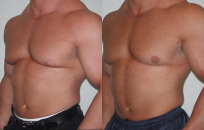 Gynecomastia Surgery before and after photo
