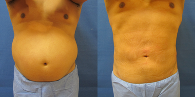 Liposculpture before and after photo