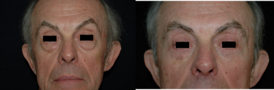 Eyelid Surgery before and after photo