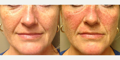 IPL before and after photo