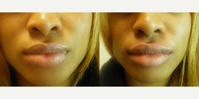 Juvederm before and after photo