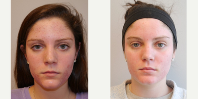 Laser Resurfacing before and after photo
