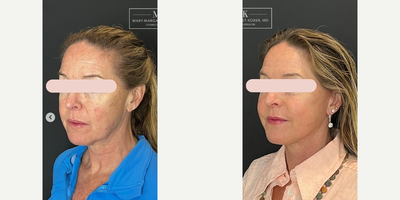 Laser Resurfacing before and after photo