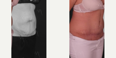 Liposuction before and after photo