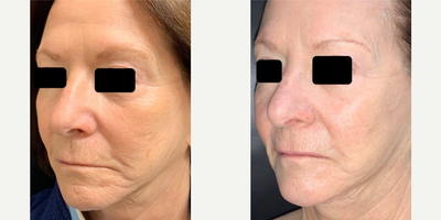 Nonsurgical Facelift before and after photo