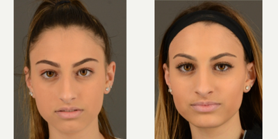 Rhinoplasty before and after photo