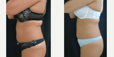 Vanquish before and after photo