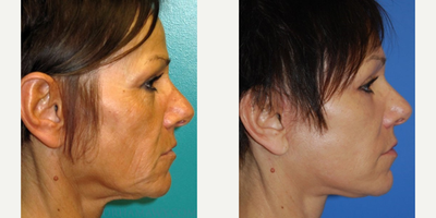 Facelift before and after photo