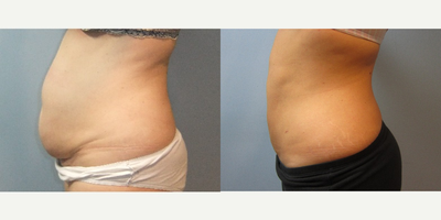 Liposuction before and after photo