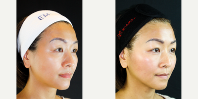 Nonsurgical Facelift before and after photo