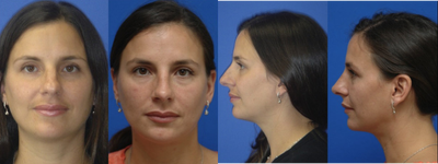 Rhinoplasty before and after photo