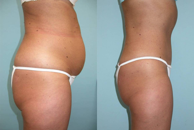 Tummy Tuck before and after photo