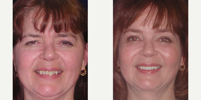 Brow Lift before and after photo