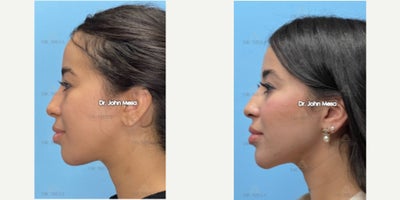 Chin Filler before and after photo