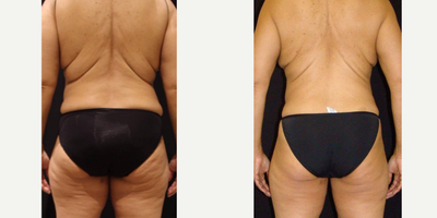 CoolSculpting before and after photo