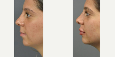 Dermal Fillers before and after photo