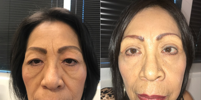Double Eyelid Surgery before and after photo