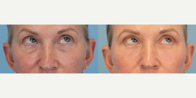 Eyelid Surgery before and after photo