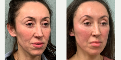 Facial Fat Transfer before and after photo