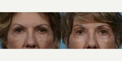 Laser Resurfacing before and after photo