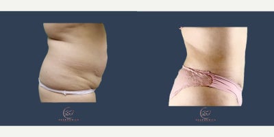 Liposuction before and after photo
