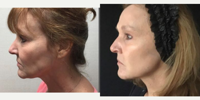 Sculptra before and after photo