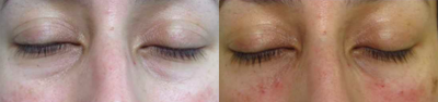 Dermal Fillers before and after photo