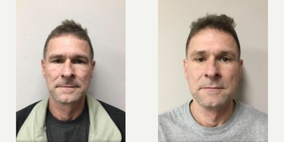 Eyelid Surgery before and after photo
