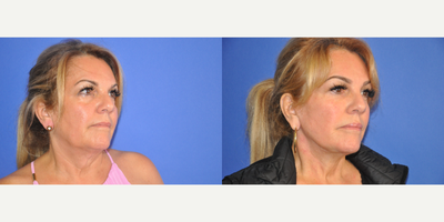 Facelift before and after photo