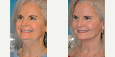 Neck Lift before and after photo