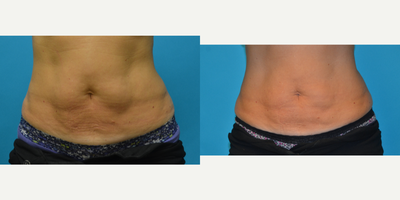 SculpSure before and after photo