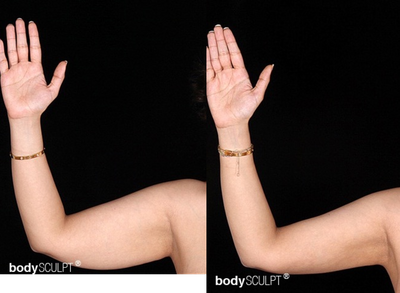 Arm Lift before and after photo