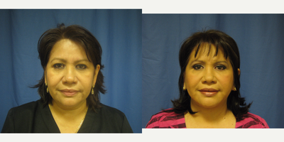 Facelift before and after photo