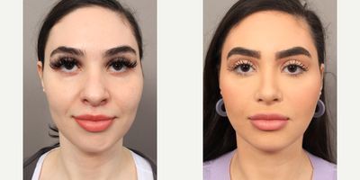 Facial Fat Transfer before and after photo