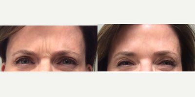 Botox before and after photo