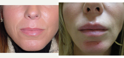 Lip Implants before and after photo