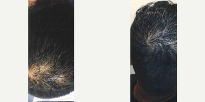 PRP for Hair Loss before and after photo