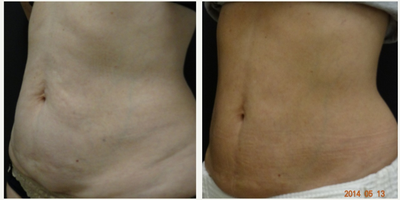 Thermage before and after photo
