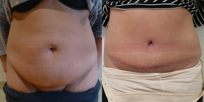Tummy Tuck before and after photo