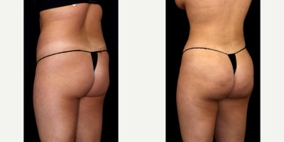 Brazilian Butt Lift before and after photo