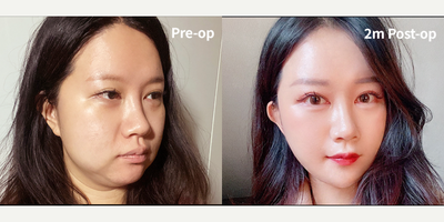 Brow Lift before and after photo